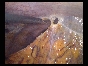 ADHESIONS BOWELS OMENTAL10 ADHESIONS BOWELS OMENTAL10
